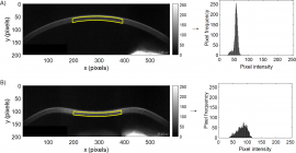 Corneal Properties of Keratoconus Based on Scheimpflug Light Intensity Distribution