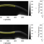 Corneal Properties of Keratoconus Based on Scheimpflug Light Intensity Distribution