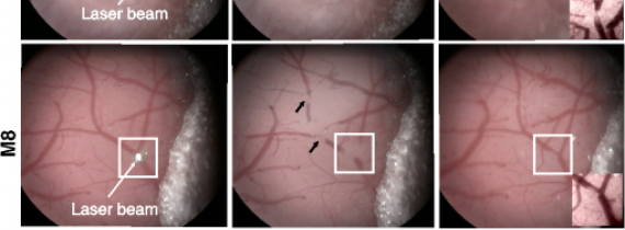 In vivo brain imaging with multimodal optical coherence microscopy in a mouse model of thromboembolic photochemical stroke